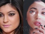 Kylie Jenner is only 17 but she too has been getting lip injections