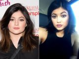 Kylie Jenner before and after lip fillers, which she probably started getting when she was 16