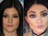 Kylie Jenner before and after alleged plastic surgery, fillers, and Botox