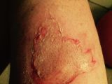 Burning iPhone causes severe wounds