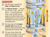 Infographic shows what this odd procedure entails