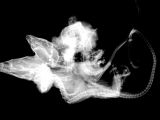 X-ray image of the conjoined twins