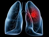 Knowing how lung cancer spreads means being able to contain it