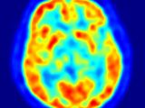 PET image of a brain showing energy consumption