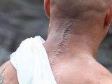 Bane has a huge scar on the back of his neck