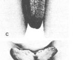 Enlarged labia minor in steatopygia