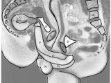The same image with explanations: P=penis, Ur=urethra, Pe=perineum, U=uterus, S=symphysis, B=bladder, I=intestine, L5=lumbar 5, Sc=scrotum