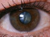 Cataract is a clouding of the eye lens