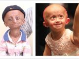 17-year old Nihal from India and 4-year old Zoey from the US, both suffering from progeria