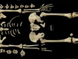 7,000-year-old skeleton shows signs of leukemia