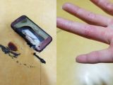 The burning phone caused blisters on the woman's hands