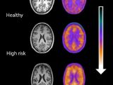 Immune activity (orange) in the brain of healthy individuals, people at risk of schizophrenia and schizophrenia patients