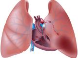 Pulmonary embolisms happen when blood clots block arteries in the lungs